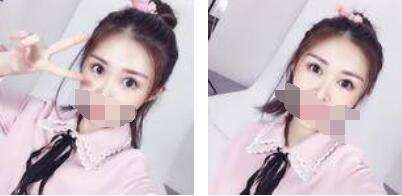 沒有了眼袋困擾，身體和心態(tài)都年輕了十歲