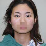 做了雙眼皮手術(shù)，讓我的眼睛更有神