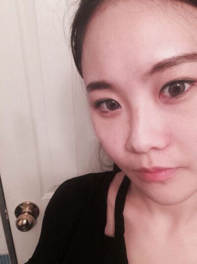 貴陽長(zhǎng)江醫(yī)院整形美容中心韓盛斌醫(yī)生做自體脂肪隆鼻+全臉填充案例