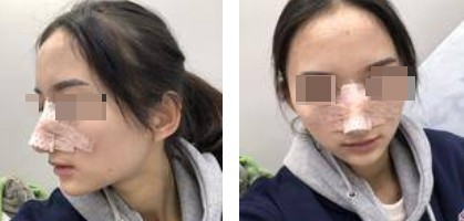 自體軟骨隆鼻案例