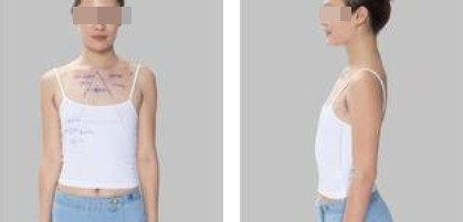 樸正淳假體隆胸案例分享