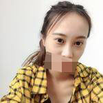 隆鼻+雙眼皮手術(shù)讓我成功蛻變，顏值達(dá)到巔峰