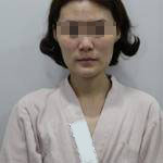 做完自體脂肪豐面頰后，我的面部比例更加完美了呢