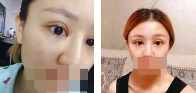 全切雙眼皮恢復(fù)過程