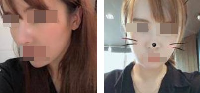 術后照片 術后照片