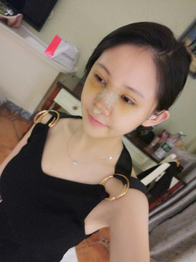 海南添美整形外科醫(yī)生王曉軍做自體軟骨隆鼻+雙眼皮+祛眼袋案例效果對比圖