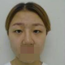 做了全切雙眼皮不僅外表變美了，內(nèi)心也更加自信了