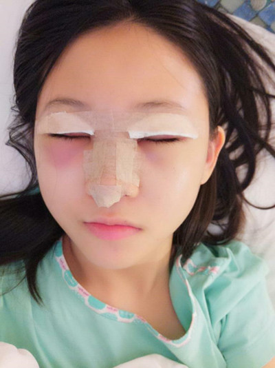 海南添美整形外科醫(yī)生王曉軍做自體軟骨隆鼻+雙眼皮+祛眼袋案例效果對比圖