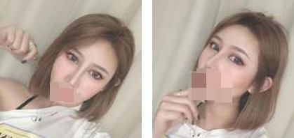 鼻綜合+眼綜合整形，讓我美的更自然，再也不用p圖了