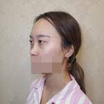 隆鼻+雙眼皮手術(shù)讓我成功蛻變，顏值達(dá)到巔峰