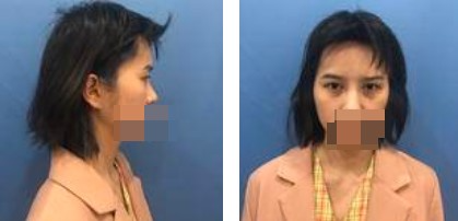 做了切開雙眼皮手術(shù)，才發(fā)現(xiàn)自己原來可以這么美！