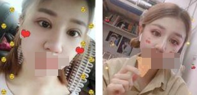 全切雙眼皮術(shù)后照片