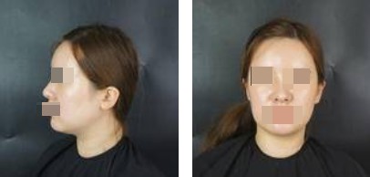 術前照片 術前照片