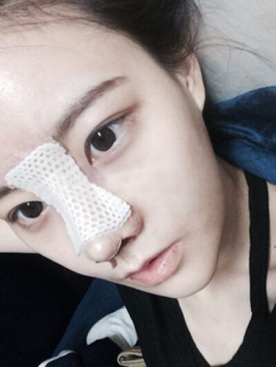 貴陽長(zhǎng)江醫(yī)院整形美容中心韓盛斌醫(yī)生做自體脂肪隆鼻+全臉填充案例