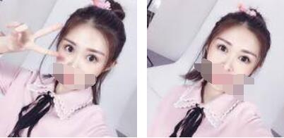 激光祛眼袋術(shù)后照片 激光祛眼袋術(shù)后照片