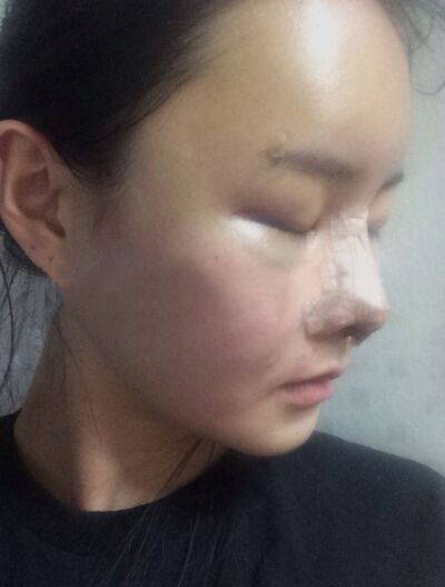 貴陽長(zhǎng)江醫(yī)院整形美容中心韓盛斌醫(yī)生做自體脂肪隆鼻+全臉填充案例
