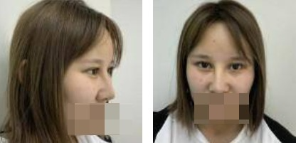 鼻綜合+眼綜合整形，讓我美的更自然，再也不用p圖了