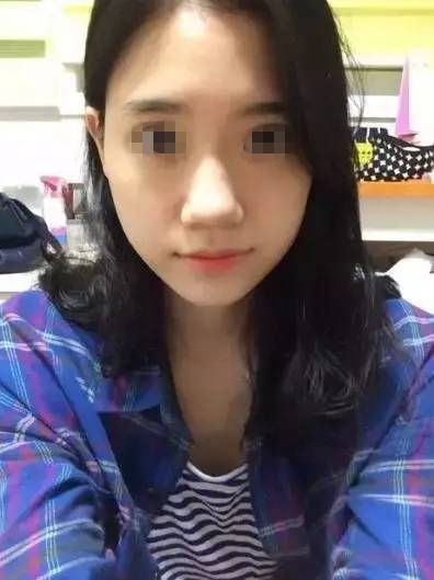 做完膨體隆鼻，鼻子變“挺”了