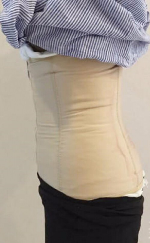 合肥壹加壹整形醫(yī)生周福田做腰腹吸脂技術(shù)怎么樣？附腰腹吸脂案例