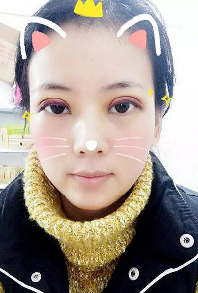 楊勇山雙眼皮案例展示