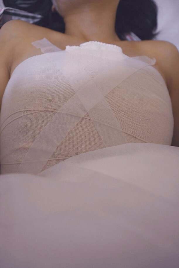 邯鄲凱潤(rùn)婷整形醫(yī)生馬戰(zhàn)勝做自體脂肪隆胸怎么樣？ 附馬戰(zhàn)勝自體脂肪隆胸案例