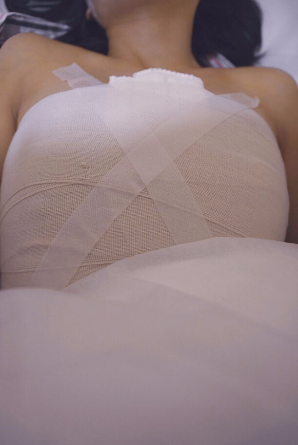 馬戰(zhàn)勝自體脂肪隆胸案例效果對(duì)比圖 馬戰(zhàn)勝自體脂肪隆胸案例效果對(duì)比圖