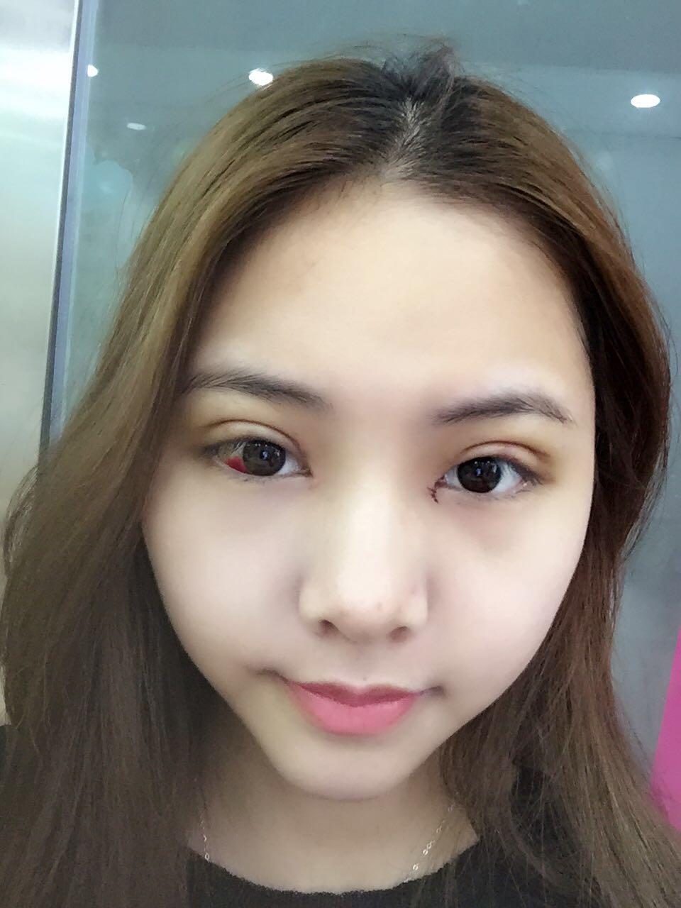 整形醫(yī)生徐長(zhǎng)亮做切開雙眼皮案例效果對(duì)比圖 整形醫(yī)生徐長(zhǎng)亮做切開雙眼皮案例效果對(duì)比圖