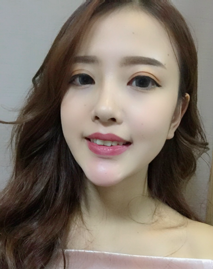 成都漢密爾頓美容醫(yī)院做牙齒矯正怎么樣？成都漢密爾頓牙齒矯正案例