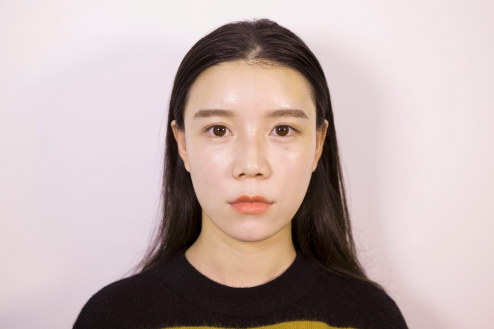 山西伊特雅整形醫(yī)生王鳳芹自體脂肪豐面頰+V-LINE瓜子臉手術(shù)案例效果圖