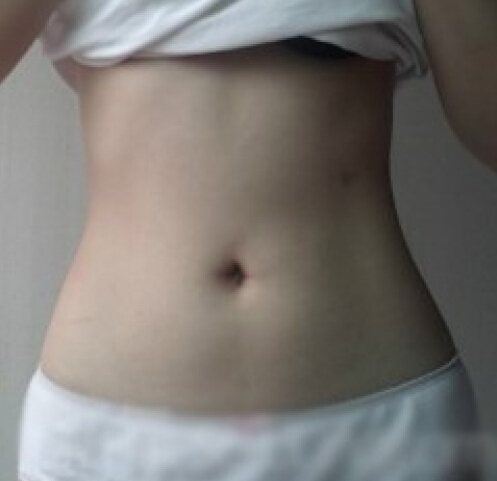 合肥壹加壹整形醫(yī)生周福田做腰腹吸脂案例 合肥壹加壹整形醫(yī)生周福田做腰腹吸脂案例