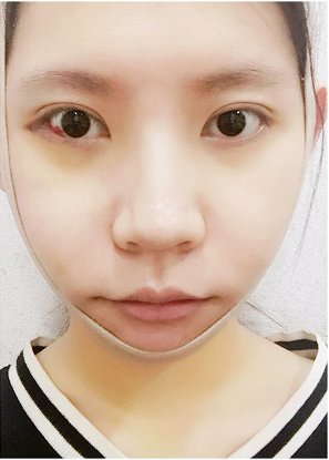 濟(jì)南安美醫(yī)療整形醫(yī)生李思思下頜角整形案例 濟(jì)南安美醫(yī)療整形醫(yī)生李思思下頜角整形案例