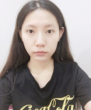  濟(jì)南安美醫(yī)療整形醫(yī)生李思思做下頜角整形怎么樣？李思思下頜角整形案例