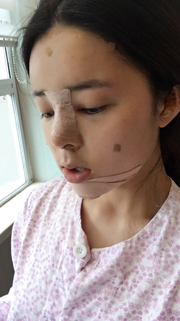 北京世濟(jì)周志強(qiáng)醫(yī)生鼻綜合案例