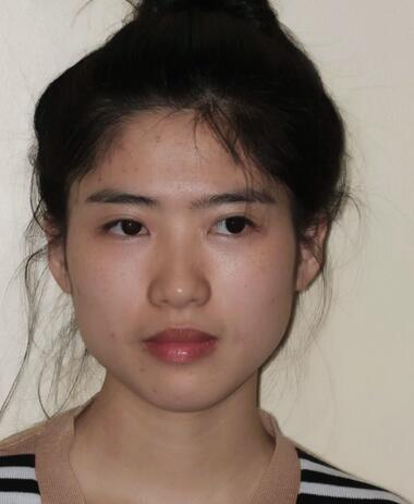 北京彤美整形醫(yī)院趙彤醫(yī)生做下頜角整形怎么樣？下頜角整形案例展示