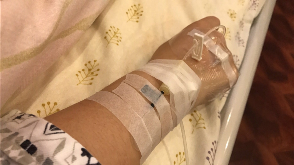 劉光偉全身吸脂案例