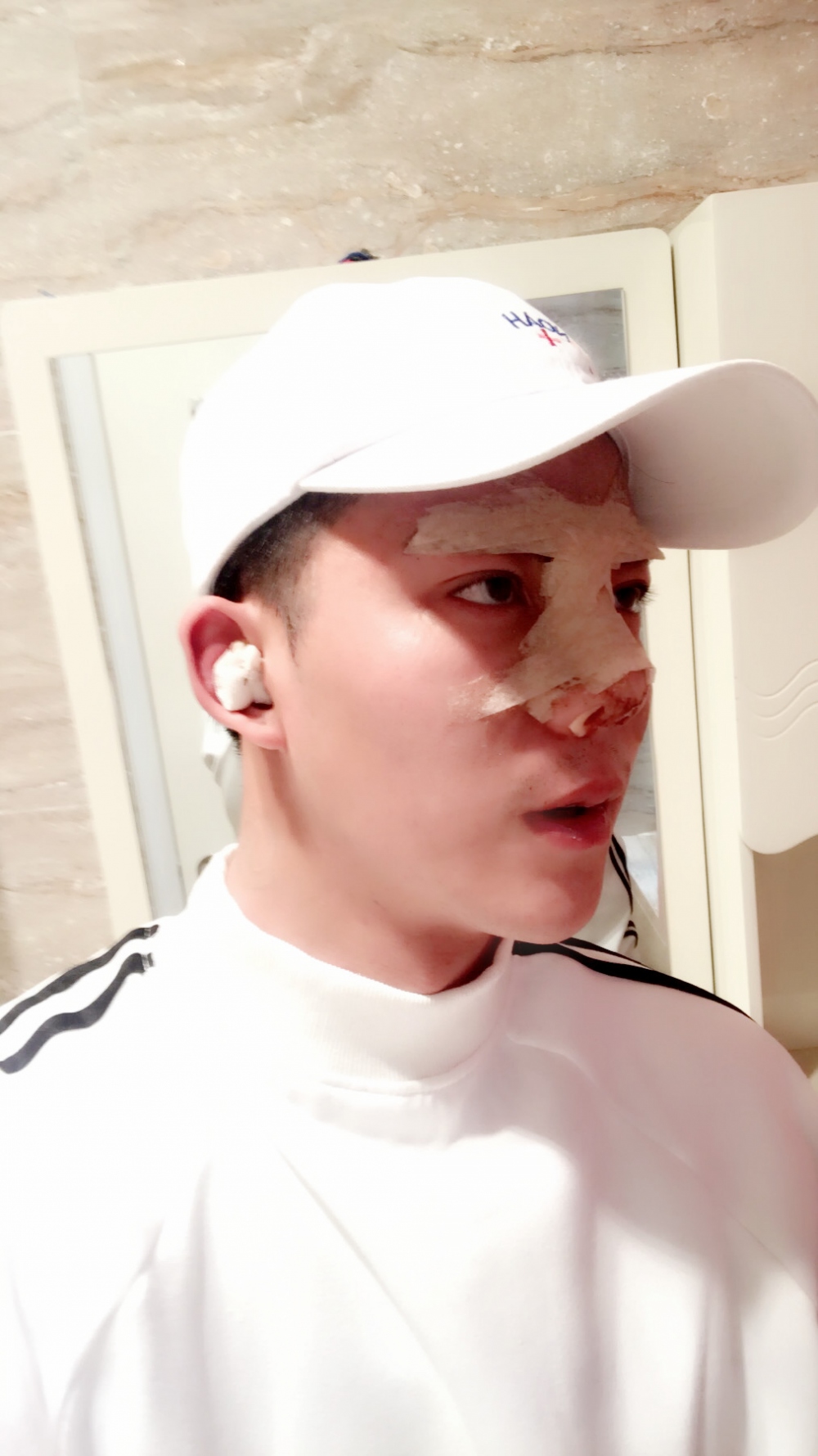 濟(jì)寧名美醫(yī)療整形醫(yī)生李唯少假體隆鼻+耳軟骨墊鼻尖真實(shí)案例效果對(duì)比圖 濟(jì)寧名美醫(yī)療整形醫(yī)生李唯少假體隆鼻+耳軟骨墊鼻尖真實(shí)案例效果對(duì)比圖