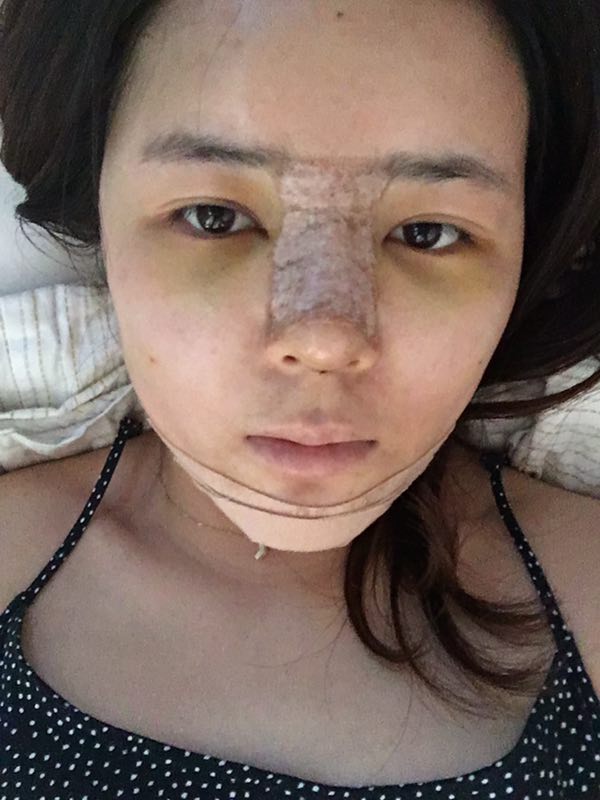 北京世濟(jì)周志強(qiáng)醫(yī)生鼻綜合案例