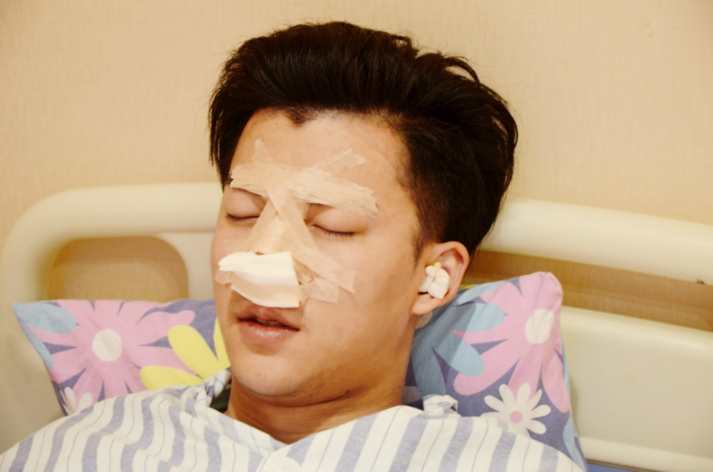 濟(jì)寧名美醫(yī)療整形醫(yī)生李唯少假體隆鼻+耳軟骨墊鼻尖真實案例效果對比圖