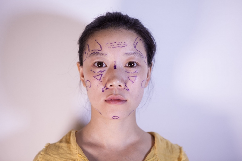 山西伊特雅整形醫(yī)生王鳳芹自體脂肪豐面頰+V-LINE瓜子臉手術(shù)案例效果圖