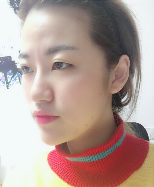 成都藝星醫(yī)療美容醫(yī)院陳遠(yuǎn)琨醫(yī)生做注射肉毒素瘦臉效果怎么樣？附案例