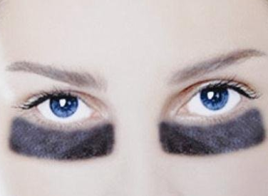 長沙松禾醫(yī)療美容診所激光去黑眼圈