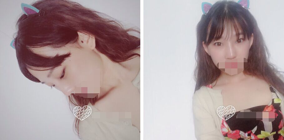 珠海艾瑞醫(yī)療美容醫(yī)院余昌盛醫(yī)生做耳軟骨隆鼻真實案例分享