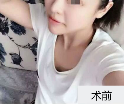 深圳博美整形醫(yī)生劉超做自體脂肪隆胸怎么樣？自體脂肪隆胸案例