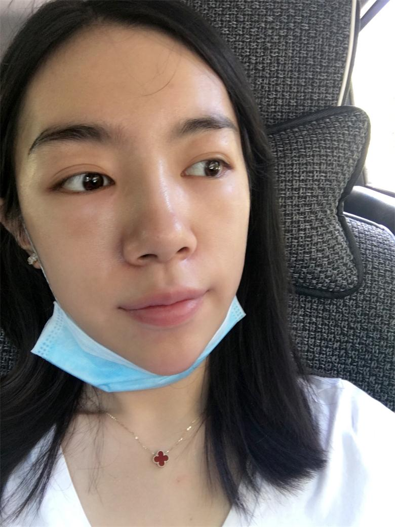 合肥壹加壹整形美容醫(yī)院做祛眼袋效果怎么樣？金大生祛眼袋案例分享