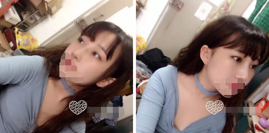 珠海艾瑞醫(yī)療美容醫(yī)院余昌盛醫(yī)生做耳軟骨隆鼻真實(shí)案例分享 珠海艾瑞醫(yī)療美容醫(yī)院余昌盛醫(yī)生做耳軟骨隆鼻真實(shí)案例分享