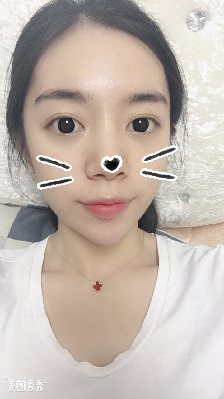 做完祛眼袋手術28天