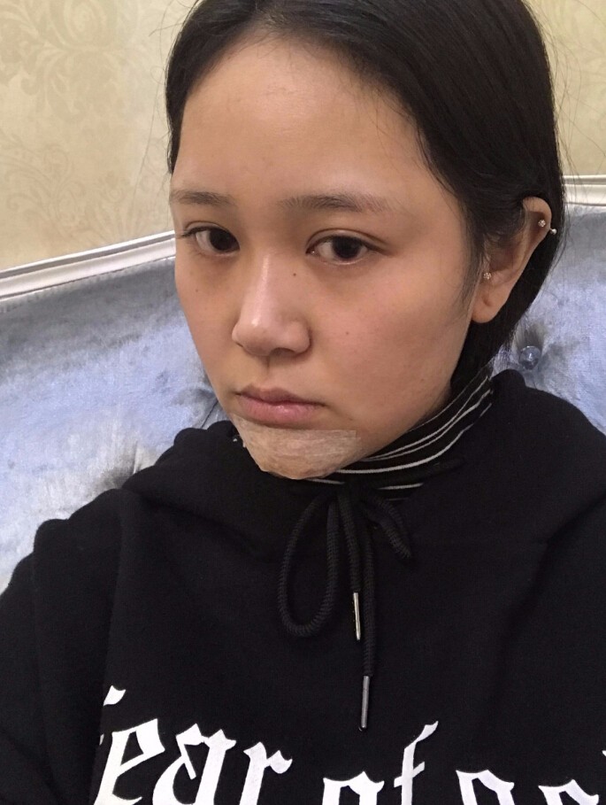 青島集美整形醫(yī)院做硅膠墊下巴怎么樣？趙煜楠醫(yī)生硅膠墊下巴真人案例