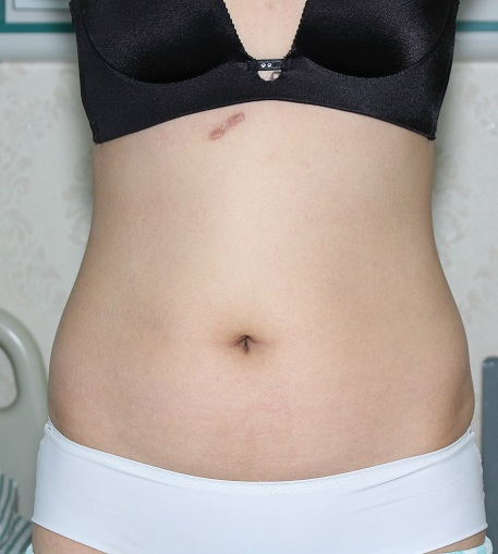 深圳晨曦整形醫(yī)院吉米斯做腰腹吸脂怎么樣？附吉米斯醫(yī)生腰腹吸脂案例