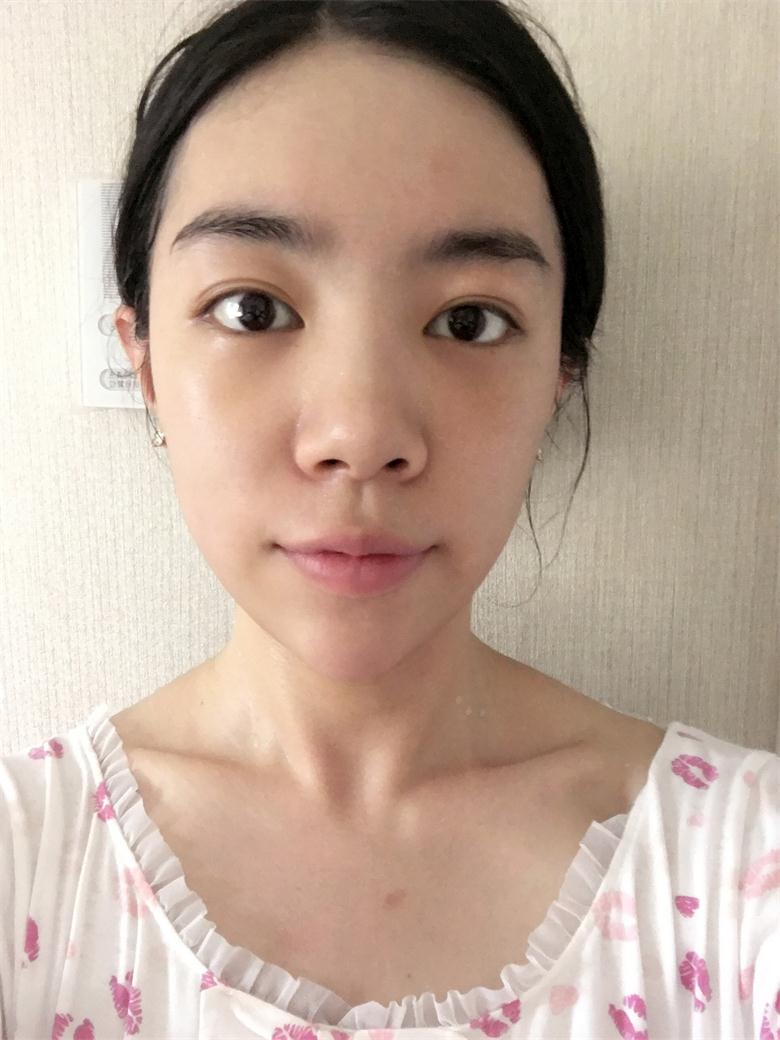 合肥壹加壹整形美容醫(yī)院做祛眼袋效果怎么樣？金大生祛眼袋案例分享