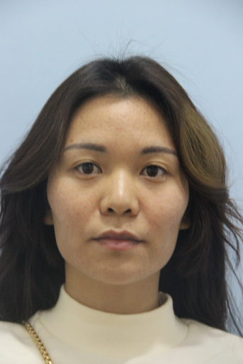 長(zhǎng)沙星雅醫(yī)療美容醫(yī)院做埋線提升去法令紋效果怎么樣？附金振玉醫(yī)生案例